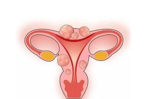 昆明女性子宫肌瘤形成的原因都有哪些？